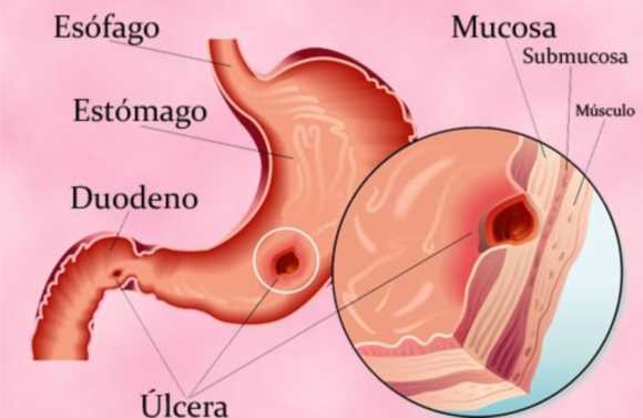 La Úlcera de Estómago